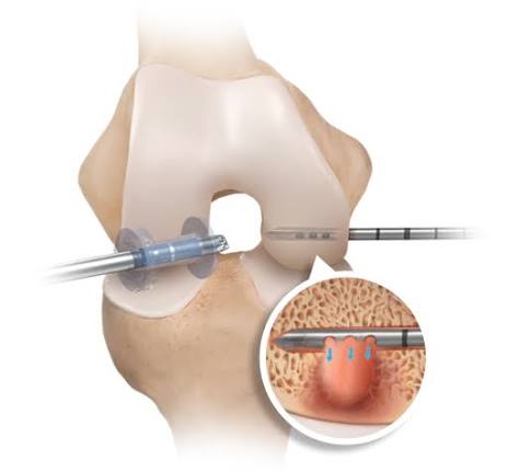 Illustration of intraosseous injection into the knee under guidance