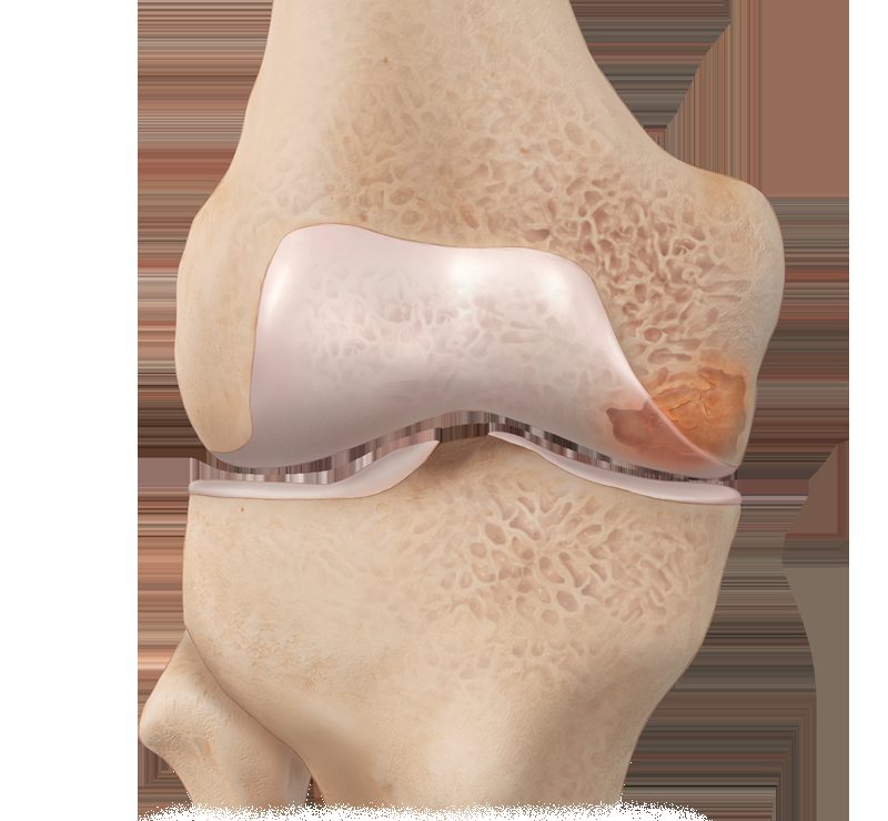 Illustration of a painful subchondral bone lesion in the knee