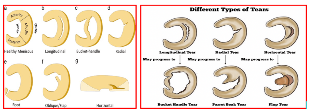 Meniscus Injuries & Management – Home | Consultant Orthopaedic Surgeon