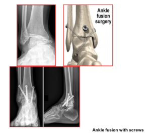 Ankle Arthritis, Fusion & Ankle Joint Replacement – Home | Consultant ...