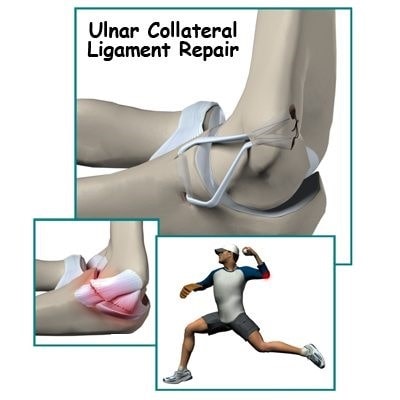 Ulnar Collateral Injuries of the Elbow – Home | Consultant Orthopaedic ...